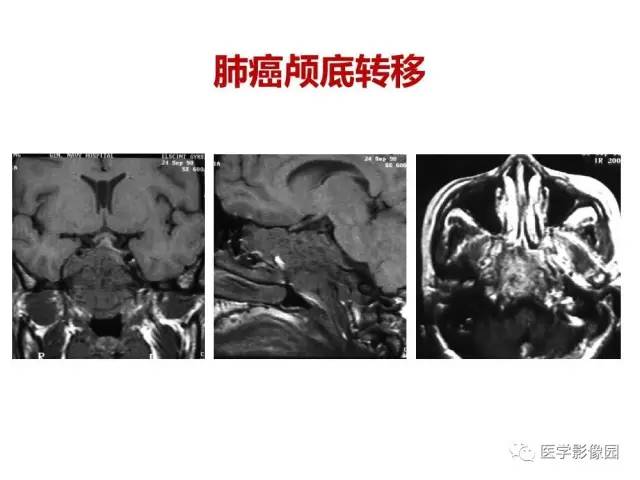 【PPT】鼻腔鼻窦肿瘤与肿瘤样病变的影像学诊断分析思路