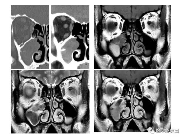 【PPT】鼻腔鼻窦肿瘤与肿瘤样病变的影像学诊断分析思路