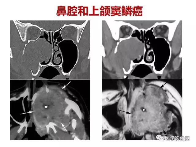 【PPT】鼻腔鼻窦肿瘤与肿瘤样病变的影像学诊断分析思路