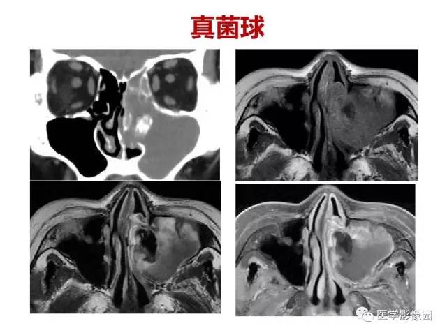 【PPT】鼻腔鼻窦肿瘤与肿瘤样病变的影像学诊断分析思路