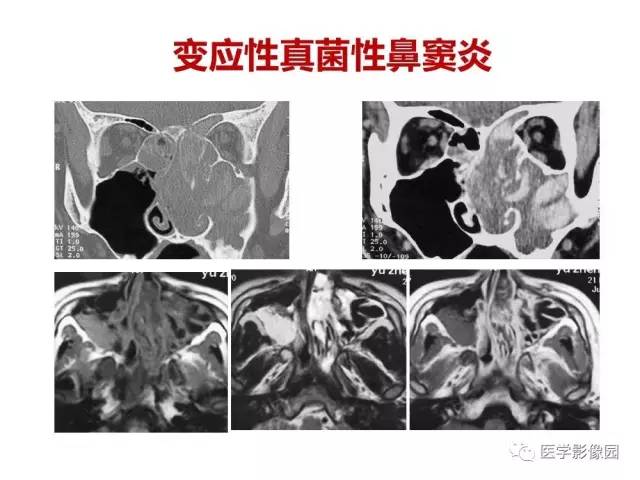 【PPT】鼻腔鼻窦肿瘤与肿瘤样病变的影像学诊断分析思路