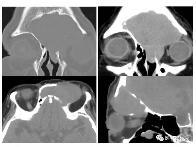 【PPT】鼻腔鼻窦肿瘤与肿瘤样病变的影像学诊断分析思路