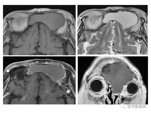【PPT】鼻腔鼻窦肿瘤与肿瘤样病变的影像学诊断分析思路