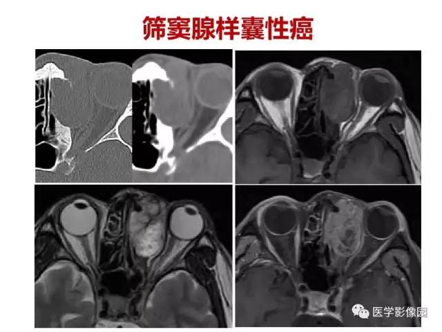【PPT】鼻腔鼻窦肿瘤与肿瘤样病变的影像学诊断分析思路
