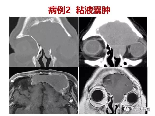 【PPT】鼻腔鼻窦肿瘤与肿瘤样病变的影像学诊断分析思路