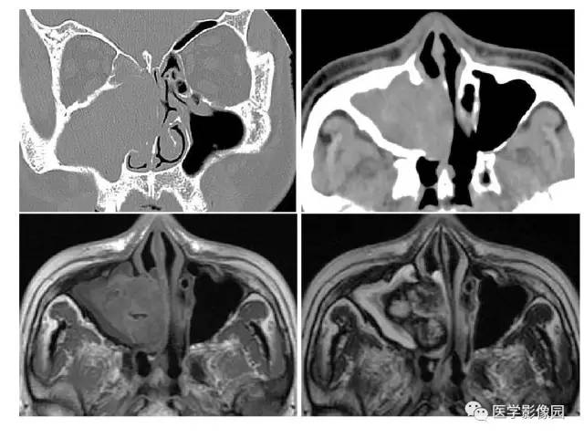 【PPT】鼻腔鼻窦肿瘤与肿瘤样病变的影像学诊断分析思路