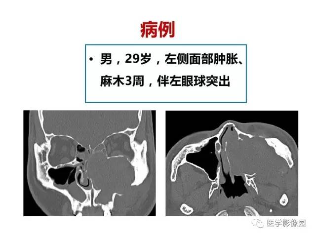 【PPT】鼻腔鼻窦肿瘤与肿瘤样病变的影像学诊断分析思路