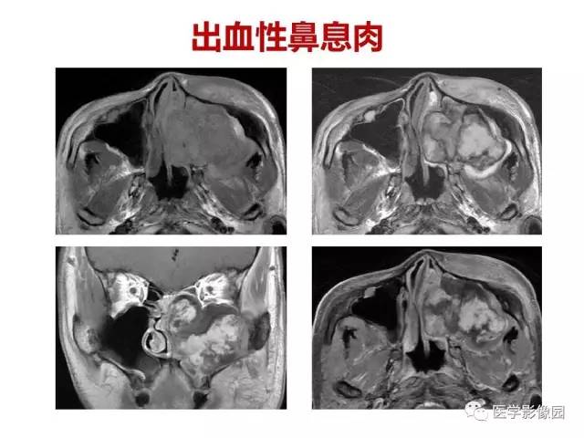 【PPT】鼻腔鼻窦肿瘤与肿瘤样病变的影像学诊断分析思路