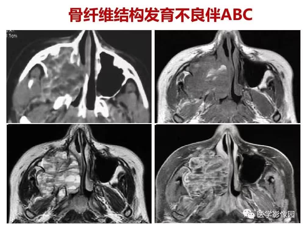 【PPT】鼻腔鼻窦肿瘤与肿瘤样病变的影像学诊断分析思路