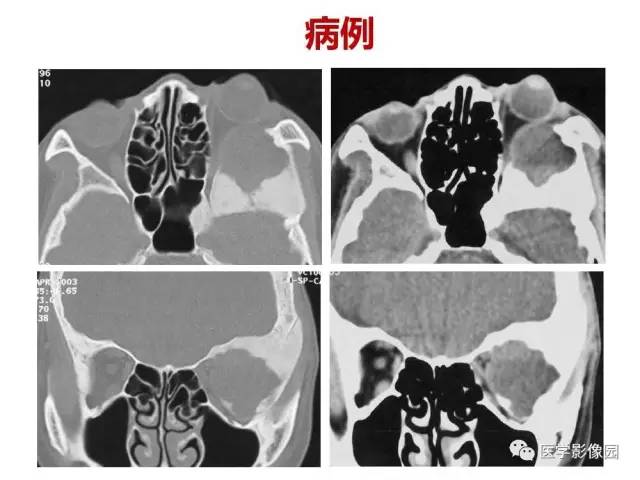【PPT】鼻腔鼻窦肿瘤与肿瘤样病变的影像学诊断分析思路
