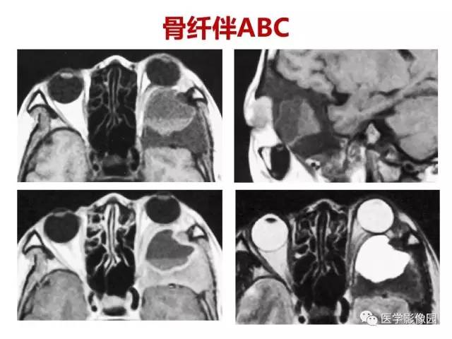 【PPT】鼻腔鼻窦肿瘤与肿瘤样病变的影像学诊断分析思路