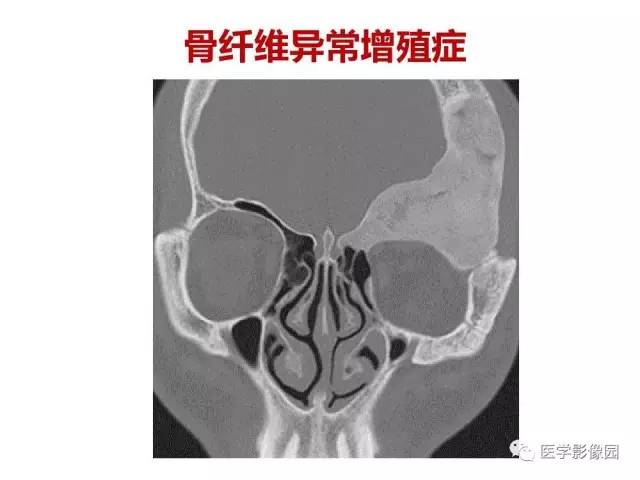 【PPT】鼻腔鼻窦肿瘤与肿瘤样病变的影像学诊断分析思路