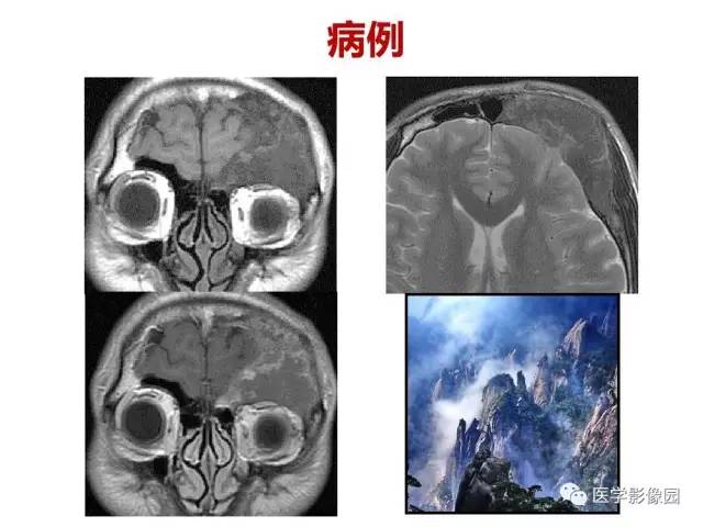 【PPT】鼻腔鼻窦肿瘤与肿瘤样病变的影像学诊断分析思路