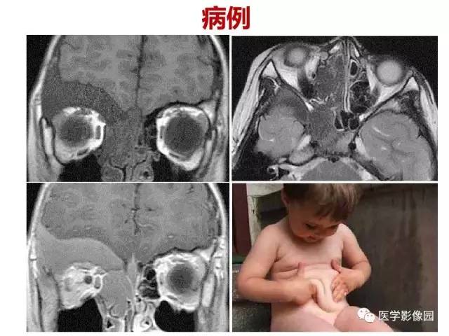 【PPT】鼻腔鼻窦肿瘤与肿瘤样病变的影像学诊断分析思路