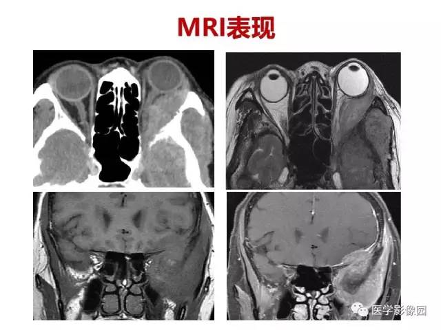【PPT】鼻腔鼻窦肿瘤与肿瘤样病变的影像学诊断分析思路