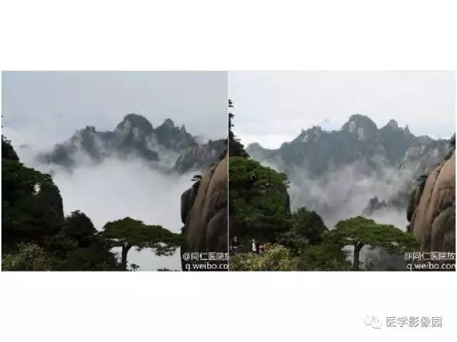 【PPT】鼻腔鼻窦肿瘤与肿瘤样病变的影像学诊断分析思路