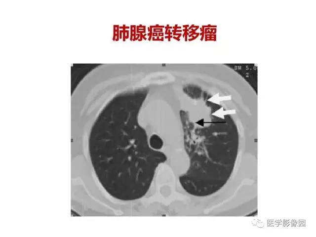 【PPT】鼻腔鼻窦肿瘤与肿瘤样病变的影像学诊断分析思路