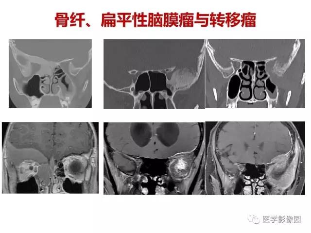 【PPT】鼻腔鼻窦肿瘤与肿瘤样病变的影像学诊断分析思路