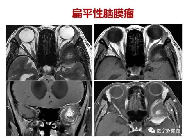 【PPT】鼻腔鼻窦肿瘤与肿瘤样病变的影像学诊断分析思路