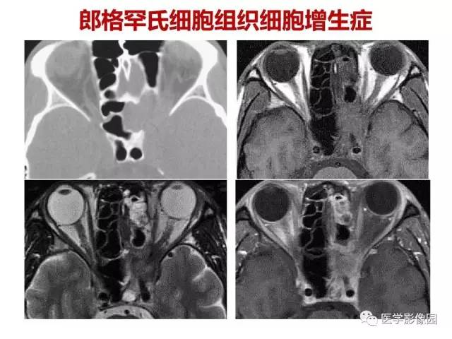 【PPT】鼻腔鼻窦肿瘤与肿瘤样病变的影像学诊断分析思路