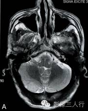 【病例】颅内血管平滑肌瘤1例MR影像表现 【病例】颅内血管平滑肌瘤1例MR影像表现