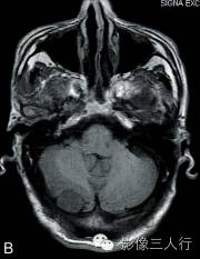 【病例】颅内血管平滑肌瘤1例MR影像表现 【病例】颅内血管平滑肌瘤1例MR影像表现
