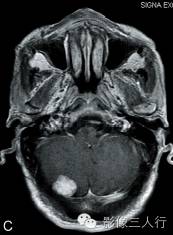 【病例】颅内血管平滑肌瘤1例MR影像表现 【病例】颅内血管平滑肌瘤1例MR影像表现