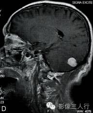 【病例】颅内血管平滑肌瘤1例MR影像表现 【病例】颅内血管平滑肌瘤1例MR影像表现
