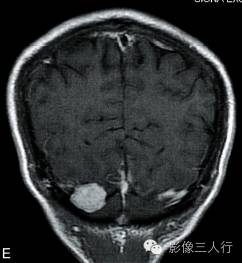 【病例】颅内血管平滑肌瘤1例MR影像表现 【病例】颅内血管平滑肌瘤1例MR影像表现