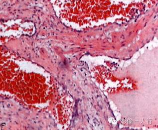 【病例】颅内血管平滑肌瘤1例MR影像表现 【病例】颅内血管平滑肌瘤1例MR影像表现