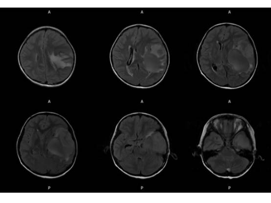 【病例】左颞血管周细胞瘤1例MR