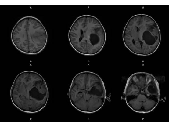 【病例】左颞血管周细胞瘤1例MR