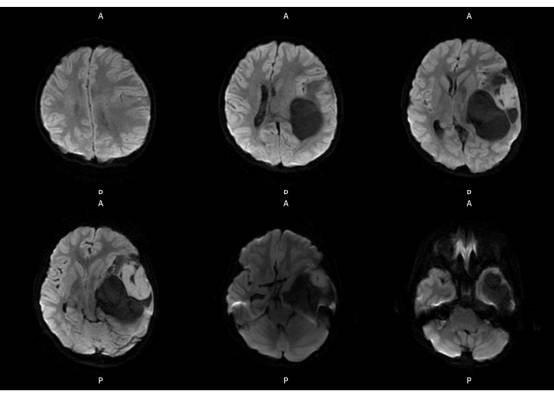 【病例】左颞血管周细胞瘤1例MR