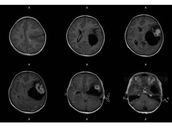 【病例】左颞血管周细胞瘤1例MR