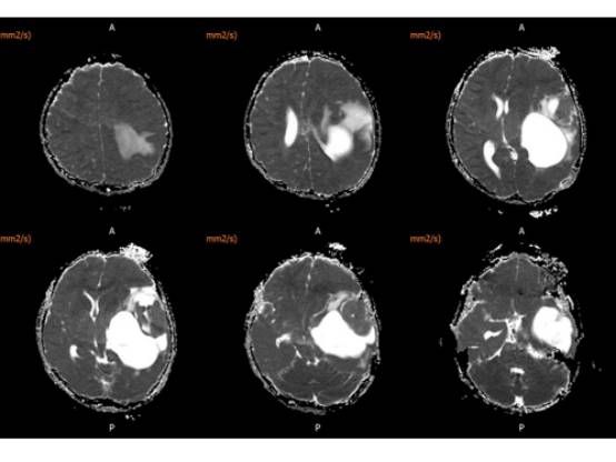 【病例】左颞血管周细胞瘤1例MR
