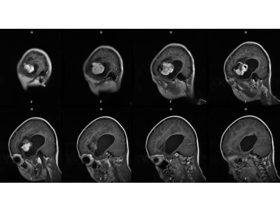 【病例】左颞血管周细胞瘤1例MR