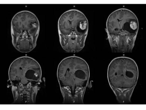 【病例】左颞血管周细胞瘤1例MR