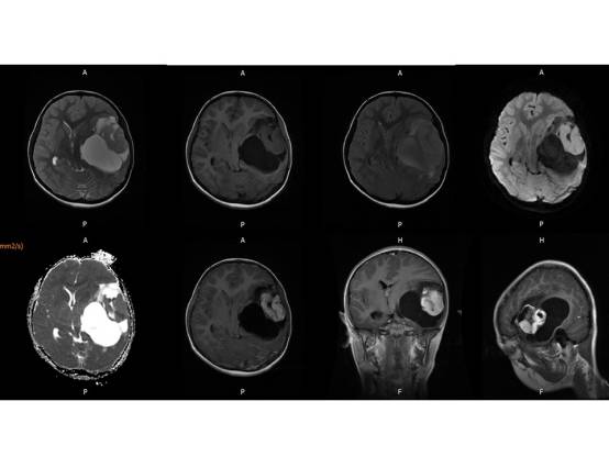 【病例】左颞血管周细胞瘤1例MR