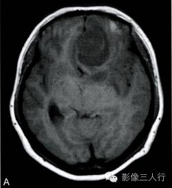 【病例】右额部神经纤维瘤1例MR影像分析