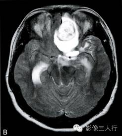 【病例】右额部神经纤维瘤1例MR影像分析