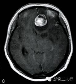 【病例】右额部神经纤维瘤1例MR影像分析