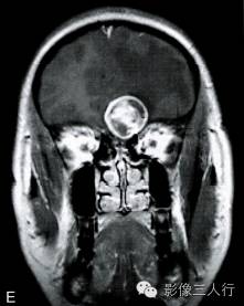 【病例】右额部神经纤维瘤1例MR影像分析