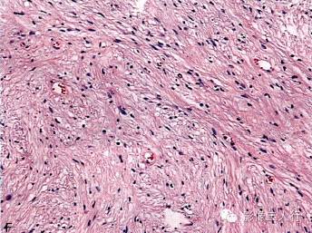 【病例】右额部神经纤维瘤1例MR影像分析