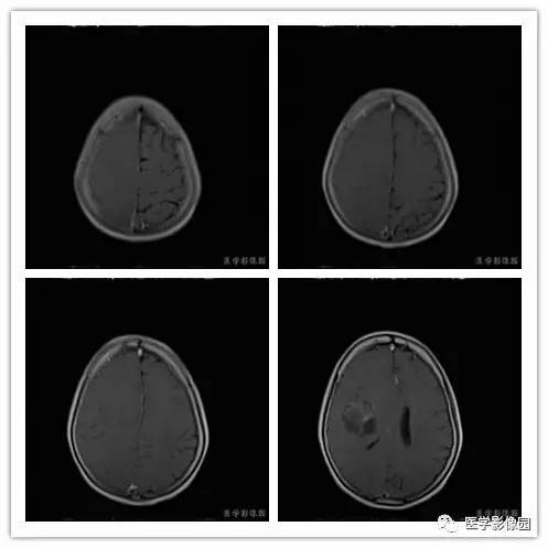 【病例】右颞部血管外皮细胞瘤1例MR