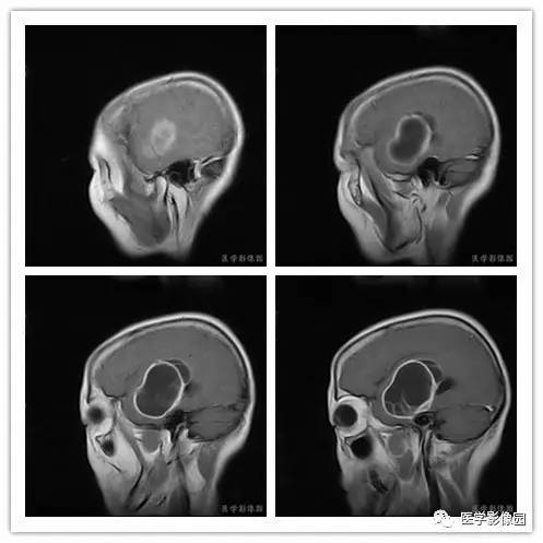【病例】右颞部血管外皮细胞瘤1例MR