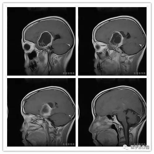 【病例】右颞部血管外皮细胞瘤1例MR