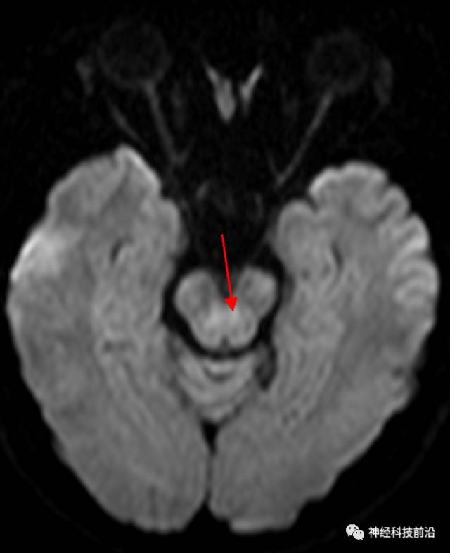 DWI序列脑干、内囊后肢高信号纤维束解析