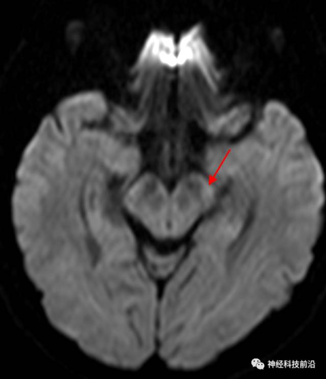 DWI序列脑干、内囊后肢高信号纤维束解析