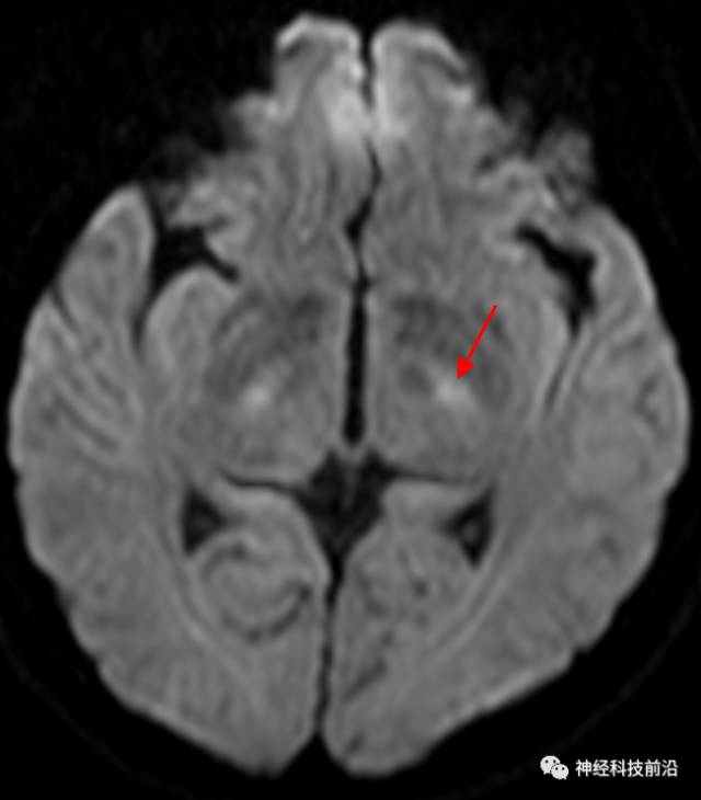DWI序列脑干、内囊后肢高信号纤维束解析