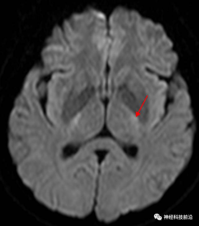 DWI序列脑干、内囊后肢高信号纤维束解析